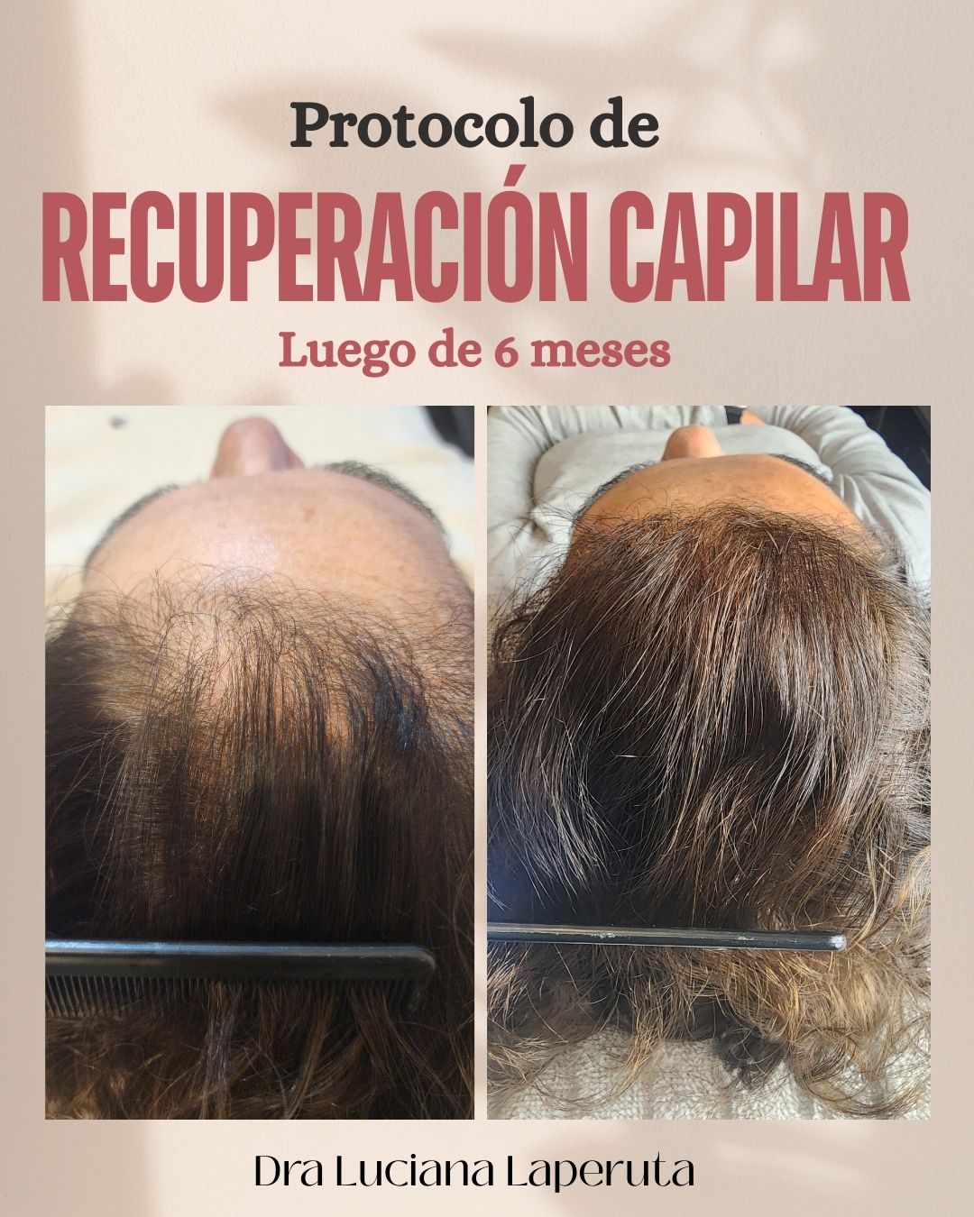 Evolución Capilar Densidad