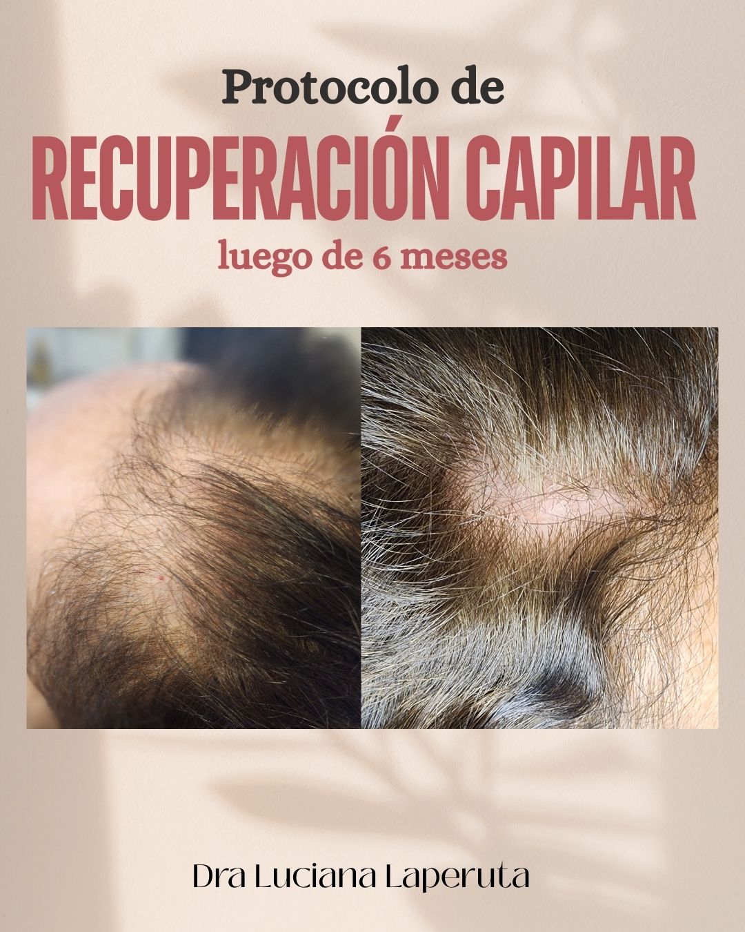 Densidad Capilar Conquistada