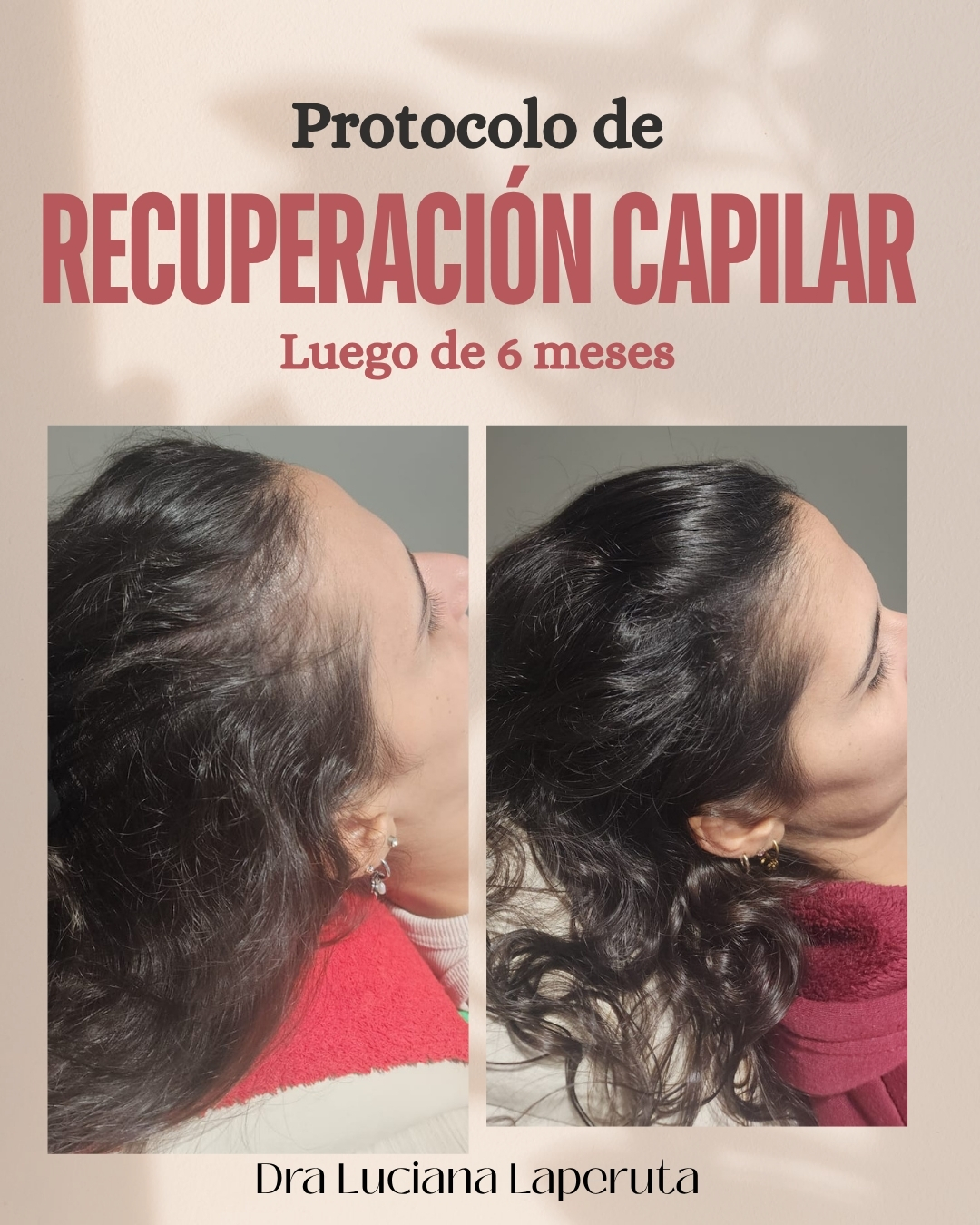 Control de Avance Capilar
